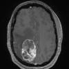 1A2 GBM, Epithelioid (Case 1) T1 with contrast - Copy