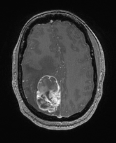 1A2 GBM, Epithelioid (Case 1) T1 with contrast - Copy