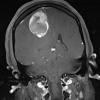 1A3 GBM, Epithelioid (Case 1) T1 with contrast 2 - Copy