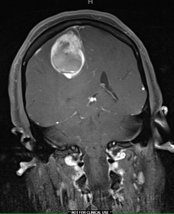 1A3 GBM, Epithelioid (Case 1) T1 with contrast 2 - Copy