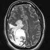 1A4 GBM, Epithelioid (Case 1) T2 with contrast - Copy