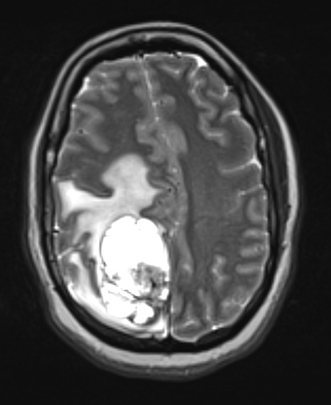 1A4 GBM, Epithelioid (Case 1) T2 with contrast - Copy