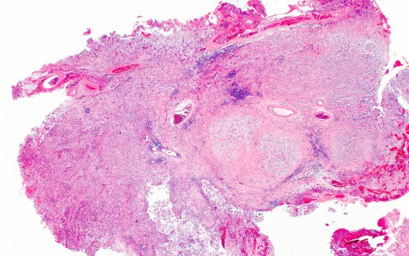 1B1 GBM, Epithelioid (Case 1) H&E 2X