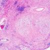 1B2 GBM, Epithelioid (Case 1) H&E 9 (2)