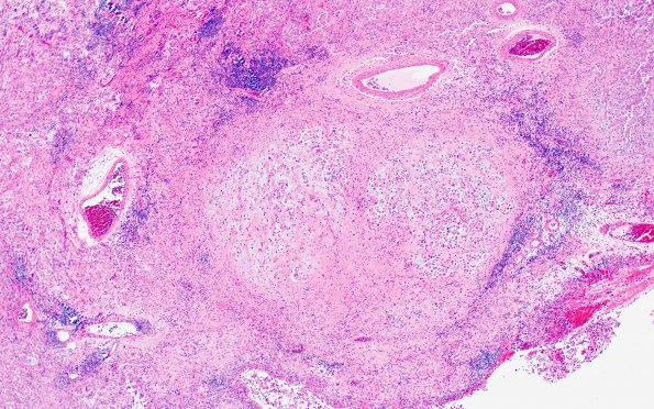 1B2 GBM, Epithelioid (Case 1) H&E 9 (2)