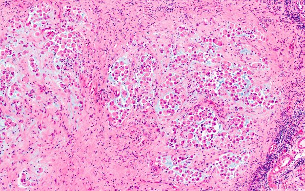 1B3 GBM, Epithelioid (Case 1) H&E 8