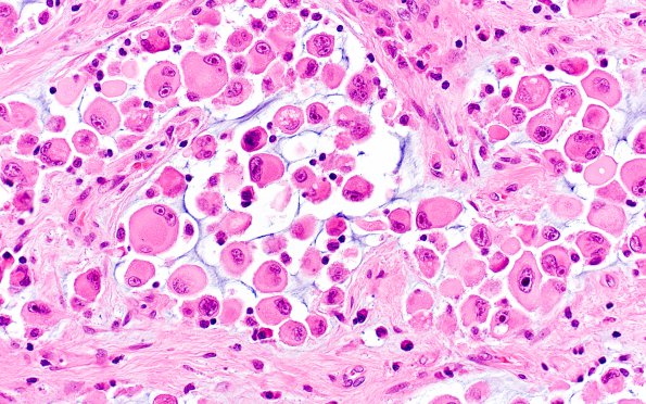 1B5 GBM, Epithelioid (Case 1) H&E 4