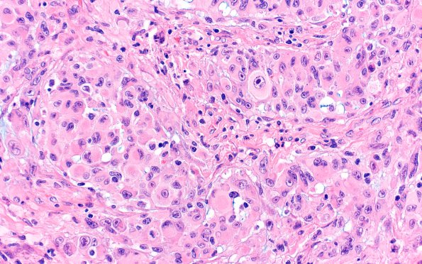 1B6 GBM, Epithelioid (Case 1) H&E 9