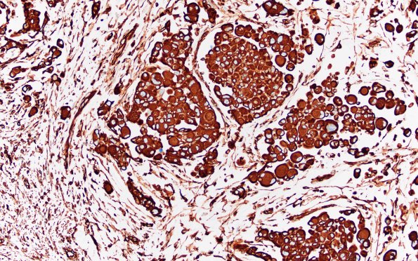 1C2 GBM, Epithelioid (Case 1) VIM 2