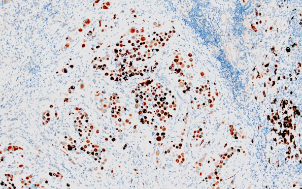 1D2 GBM, Epithelioid (Case 1) GFAP 14