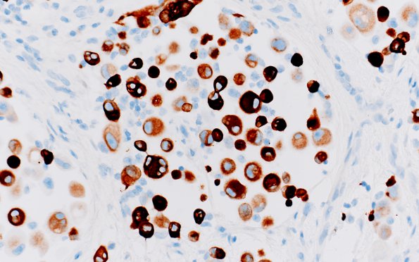 1D4 GBM, Epithelioid (Case 1) GFAP 16