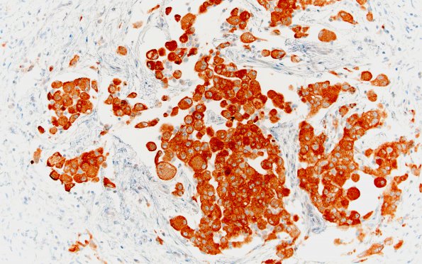 1E2 GBM, Epithelioid (Case 1) BRAFv600E 6