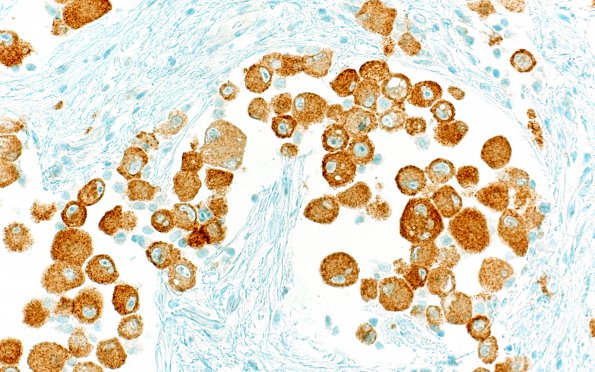 1E3 GBM, Epithelioid (Case 1) BRAFv600E 8