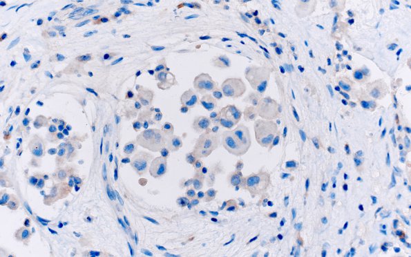 1G GBM, Epithelioid (Case 1) CAM5.2 1