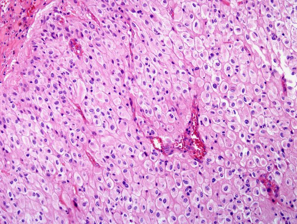 2A1 GBM, Epithelioid (Case 2) H&E 2