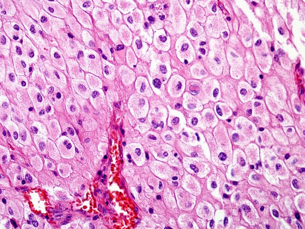 2A2 GBM, Epithelioid (Case 2) H&E 1