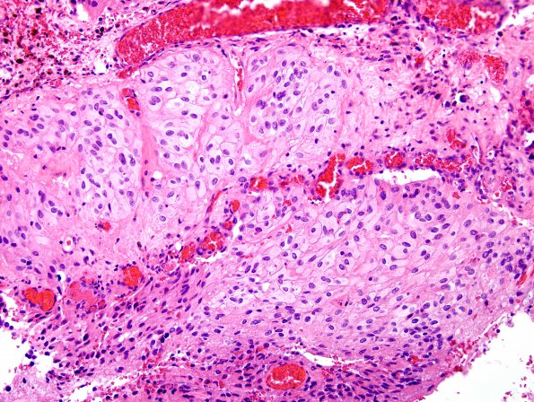 2A3 GBM, Epithelioid (Case 2) H&E 4