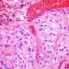 2A4 GBM, Epithelioid (Case 2) H&E 3