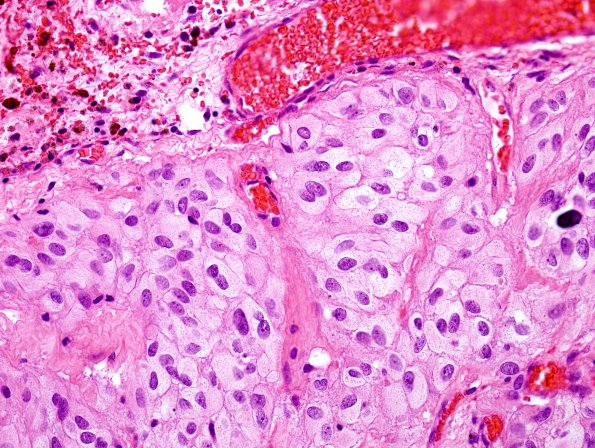 2A4 GBM, Epithelioid (Case 2) H&E 3