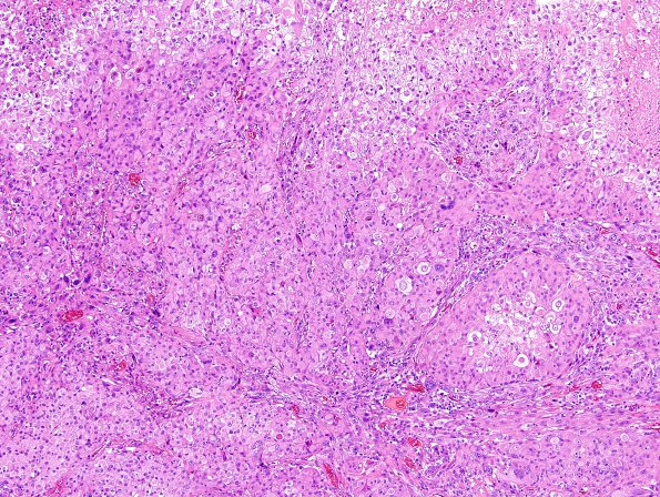 3A1 Gliosarcoma (Case 3) Epithelioid area H&E 5