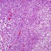 3A2 Gliosarcoma (Case 3) Epithelioid area H&E 7