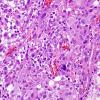 3A3 Gliosarcoma (Case 3) Epithelioid area H&E 6