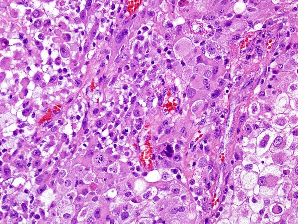 3A3 Gliosarcoma (Case 3) Epithelioid area H&E 6