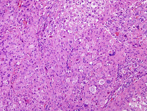 3A4 Gliosarcoma (Case 3) Epithelioid area H&E 3