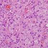 3A5 Gliosarcoma (Case 3) Epithelioid area H&E 1