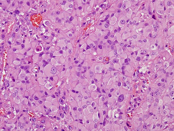 3A5 Gliosarcoma (Case 3) Epithelioid area H&E 1