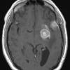 4A1 GBM w Epithelioid Features (Case 4) T1 W - Copy