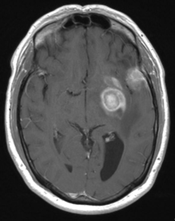 4A1 GBM w Epithelioid Features (Case 4) T1 W - Copy