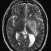 4A2 GBM w Epithelioid Features (Case 4) T2 W 2 - Copy