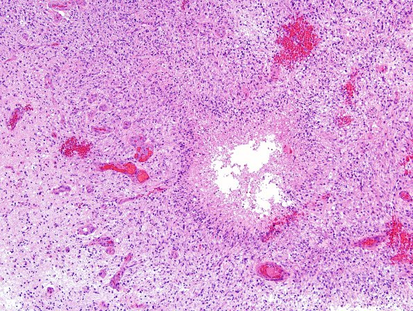 4B1 GBM w Epithelioid Features (Case 4) H&E 10.jpg