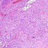 4B2 GBM w Epithelioid Features (Case 4) H&E 15.jpg