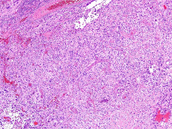 4B2 GBM w Epithelioid Features (Case 4) H&E 15.jpg