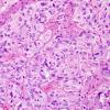 4B3 GBM w Epithelioid Features (Case 4) H&E 17.jpg