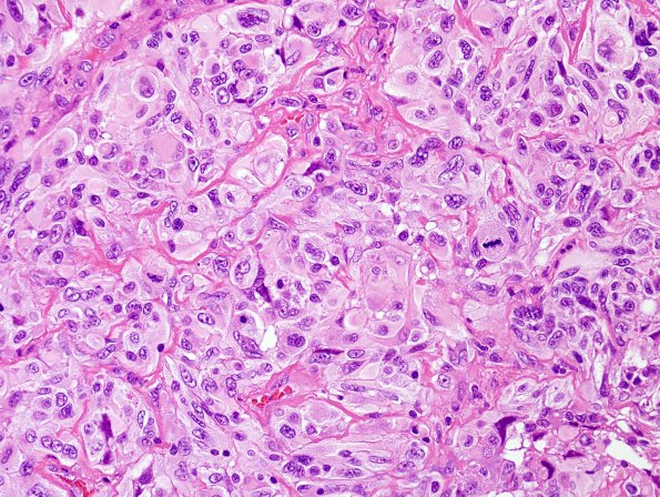 4B3 GBM w Epithelioid Features (Case 4) H&E 17.jpg