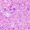 4B5 GBM w Epithelioid Features (Case 4) H&E 20.jpg