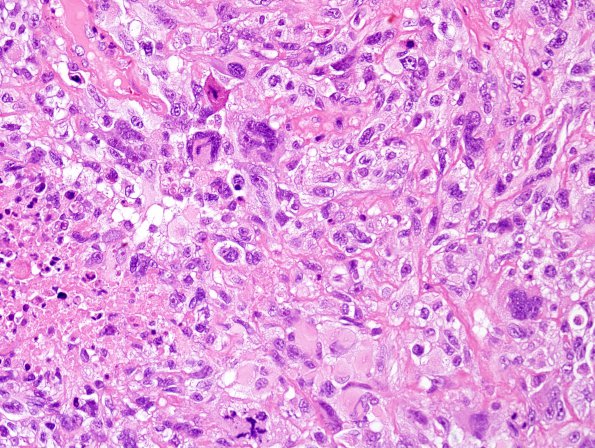 4B5 GBM w Epithelioid Features (Case 4) H&E 20.jpg