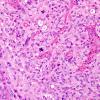 4B6 GBM w Epithelioid Features (Case 4) H&E 25.jpg