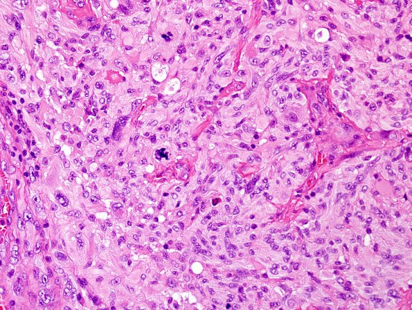 4B6 GBM w Epithelioid Features (Case 4) H&E 25.jpg