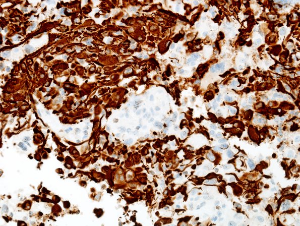 4C3 GBM w Epithelioid Features (Case 4) GFAP 5.jpg