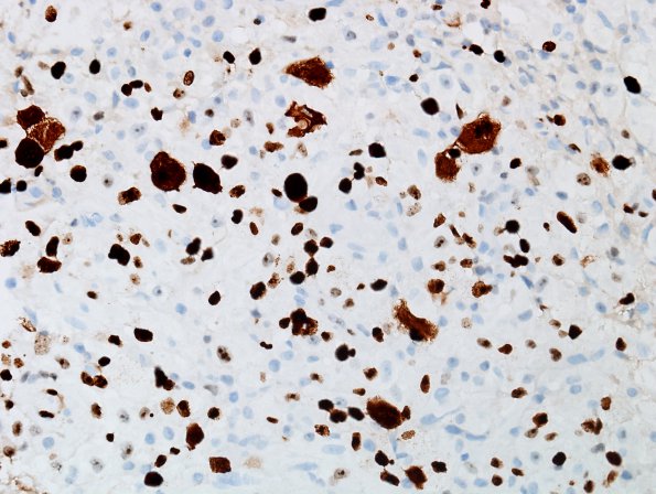 4D GBM w Epithelioid Features (Case 4) Ki67 1.jpg