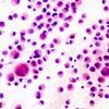 5A1 GBM, Epithelioid features (Case 5) H&E smear