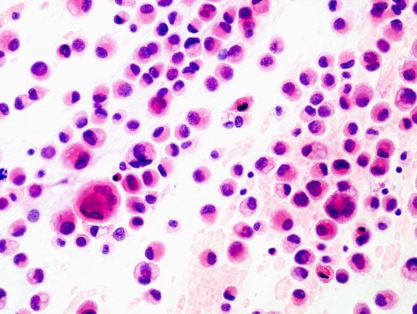 5A1 GBM, Epithelioid features (Case 5) H&E smear