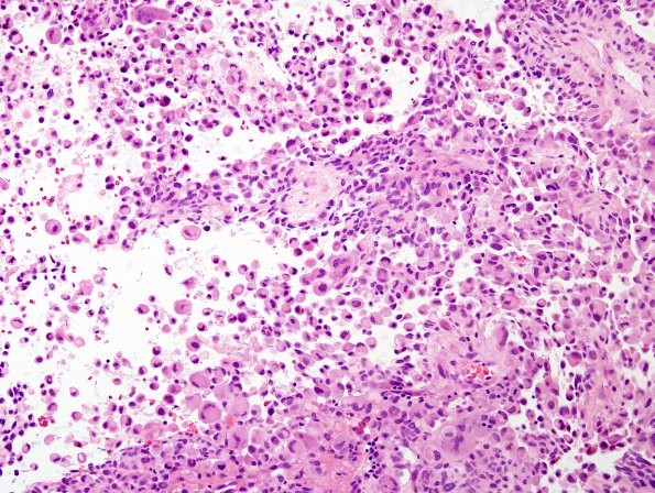 5A2 GBM, Epithelioid features (Case 5) H&E 3