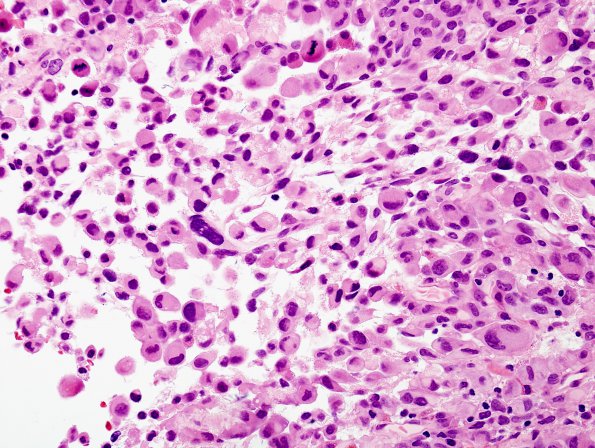 5A3 GBM, Epithelioid features (Case 5) H&E 1