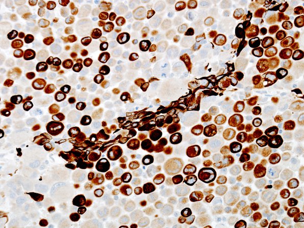 5B2 GBM, Epithelioid features (Case 5) GFAP 1