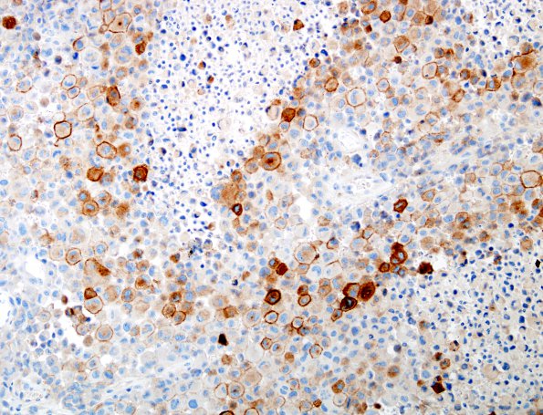 5D GBM, Epithelioid features (Case 5) EMA 1